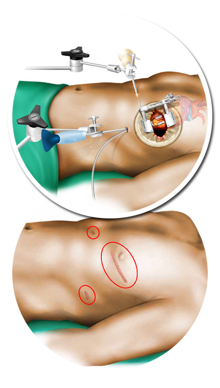 Minimal ByPass Nedir